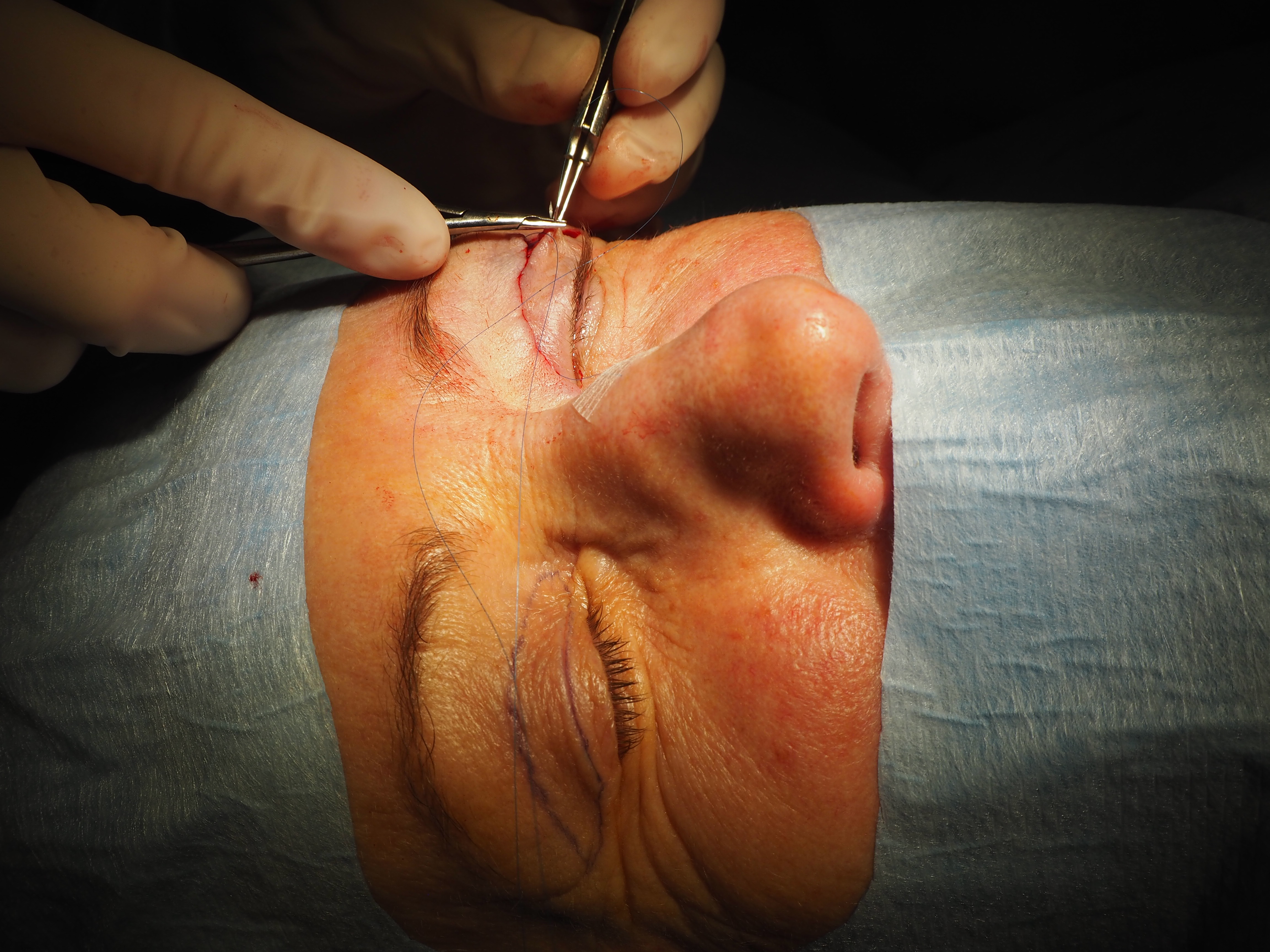 Blefaroplastika - malý zákrok, velký rozdíl 