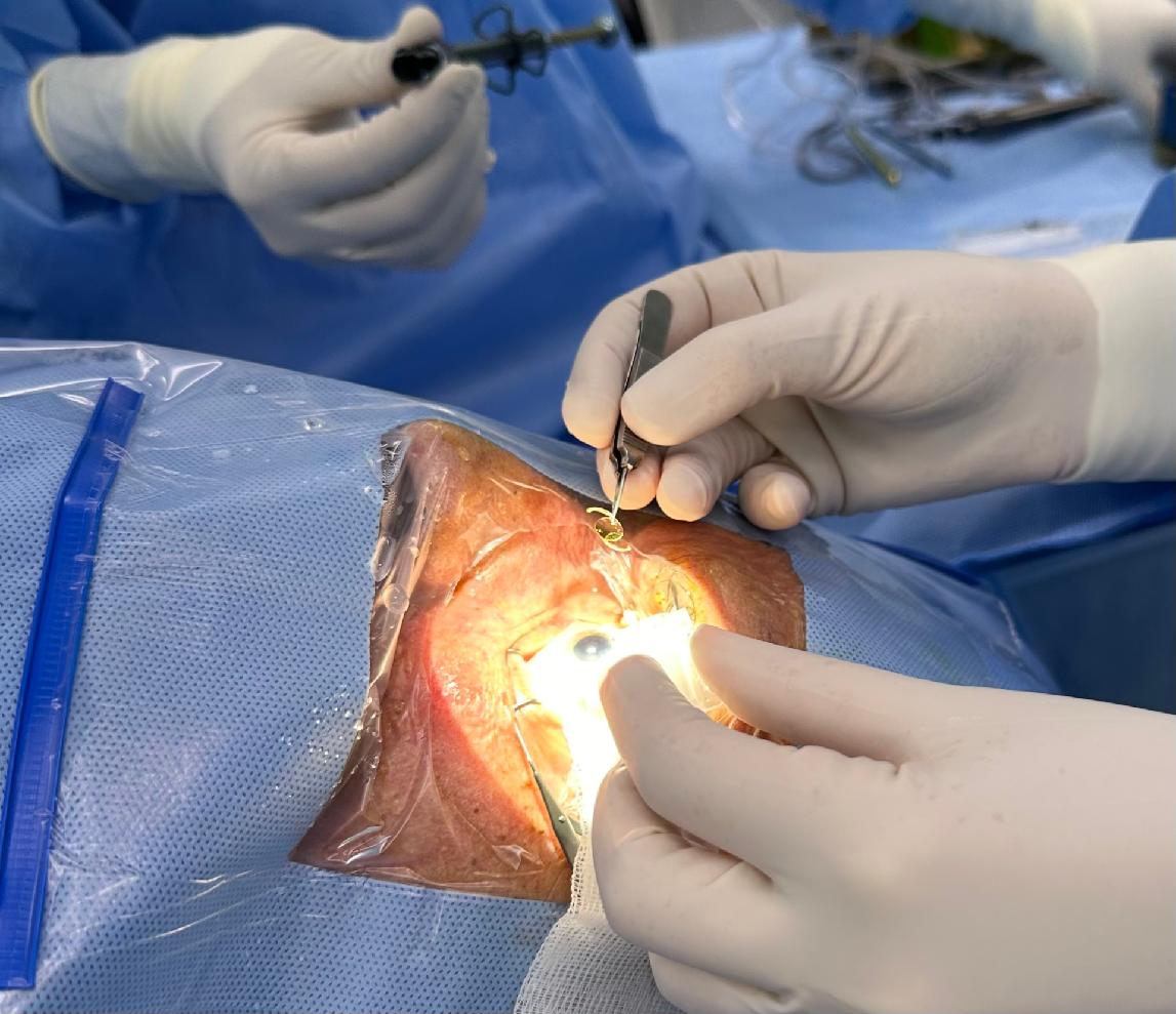 Jak vybrat vhodnou nitrooční čočku?